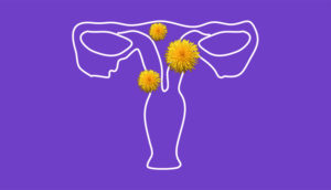 uterine-fibroids-feat