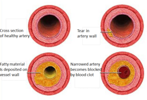 heart disease narrowed blood vessels