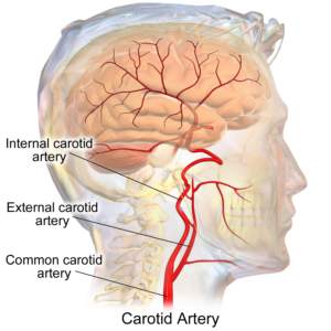 heart disease carotid artery