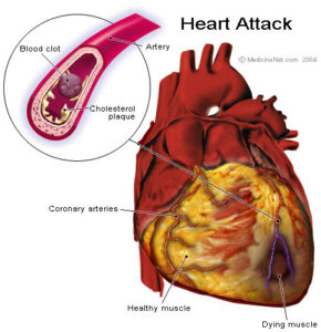 heart disease heart attack figure