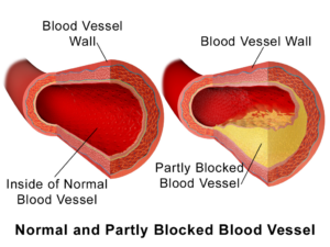 high cholesterol vessel plaque