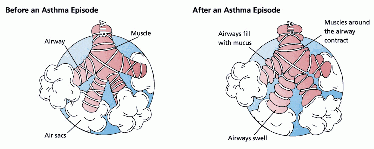 asthma before and after