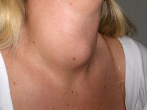 thyroid disease goiter