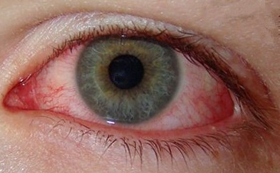 adult chlamydia eye infection
