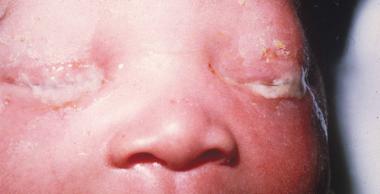 newborn chalmydia eye infection