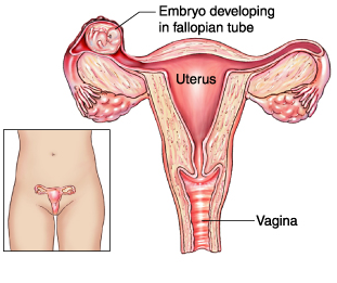 chlamydia and ectopic pregnancy