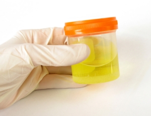 chlamydia urine testing
