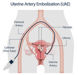 Uterine Artery Embolization.